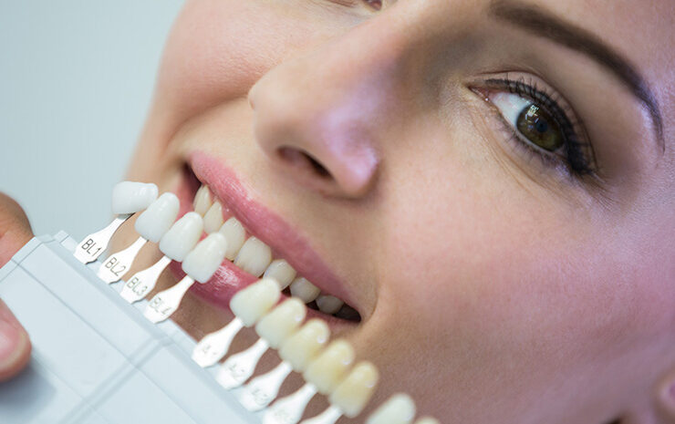  Faccette dentali estetiche